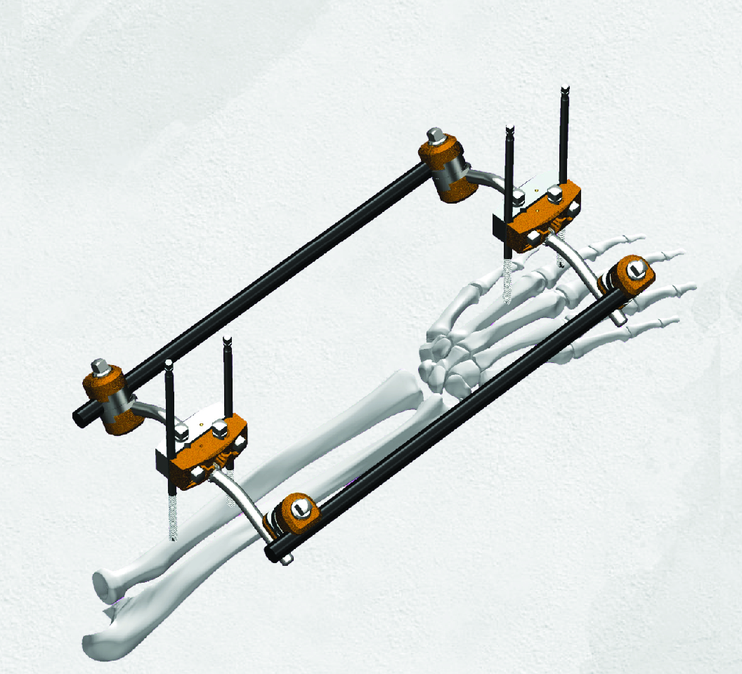 CRONUS Modular Upper Limb Fixators by Madison Ortho