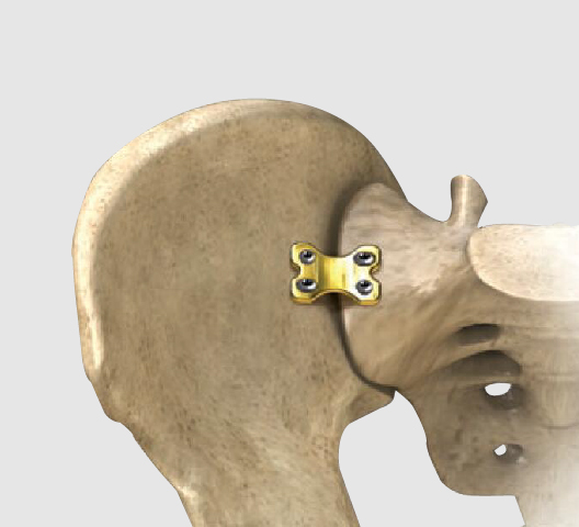 KEPLER Superior Sacroiliac Plate for posterior pelvic stabilization
