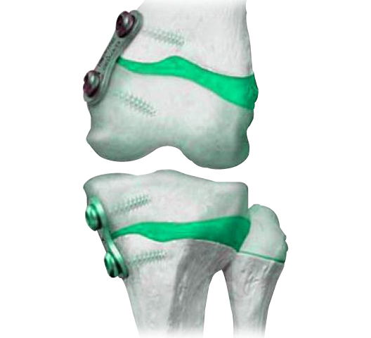 EIGHT-Q Guided Growth Plates for pediatric knee deformities