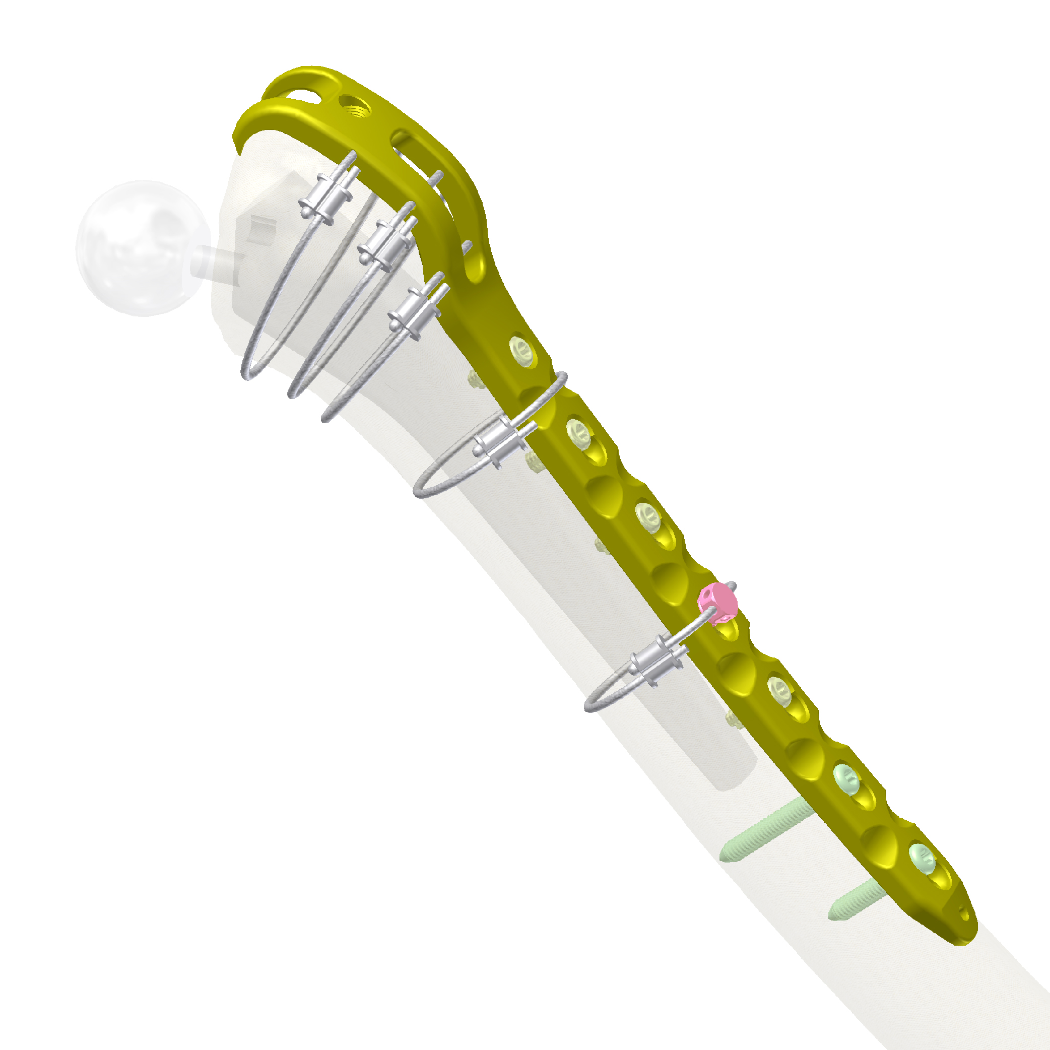 MARVEL LCP Periprosthetic Cable Plate System
