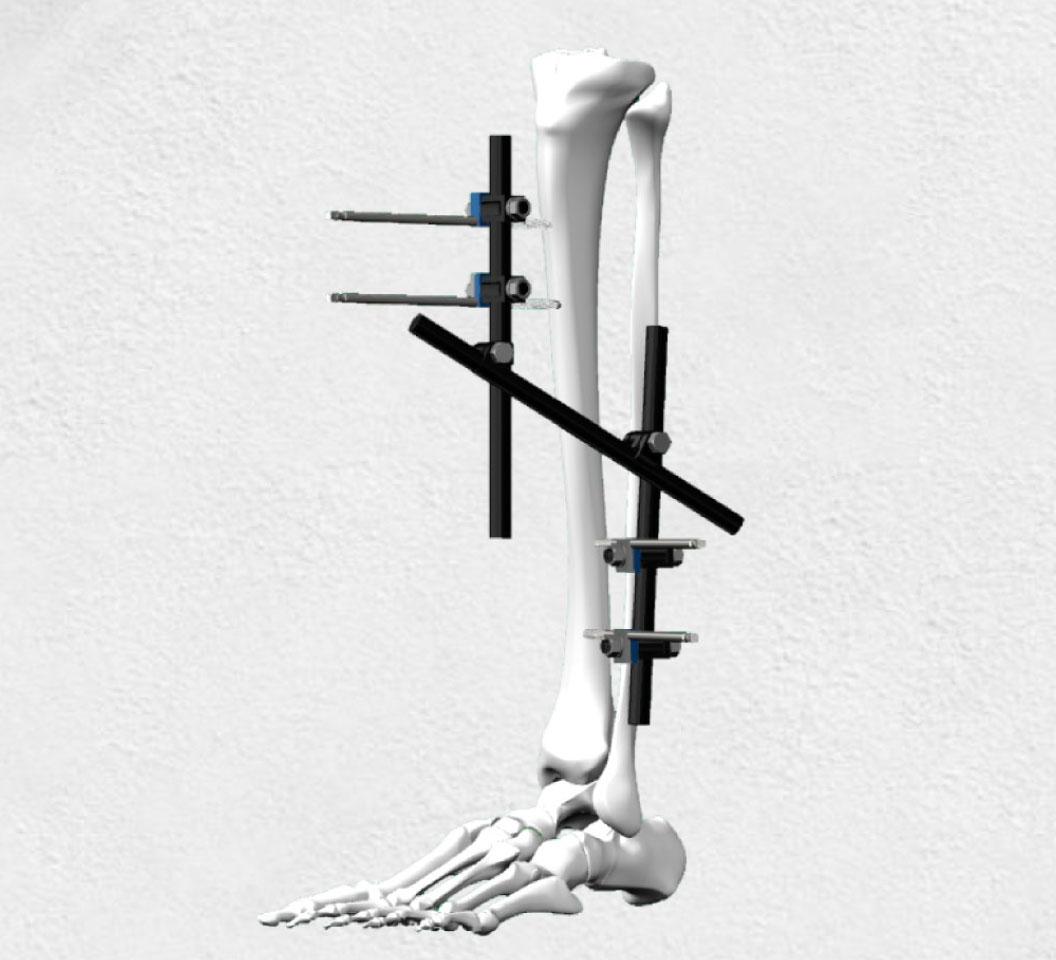 ATHENA Modular External Fixator System for Lower Limb