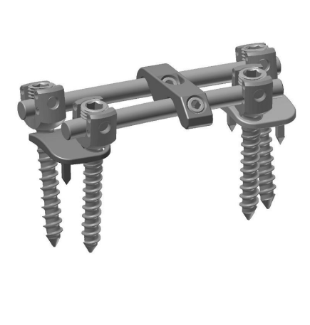 ALTAIR Anterior Thoracolumbar Fixation System