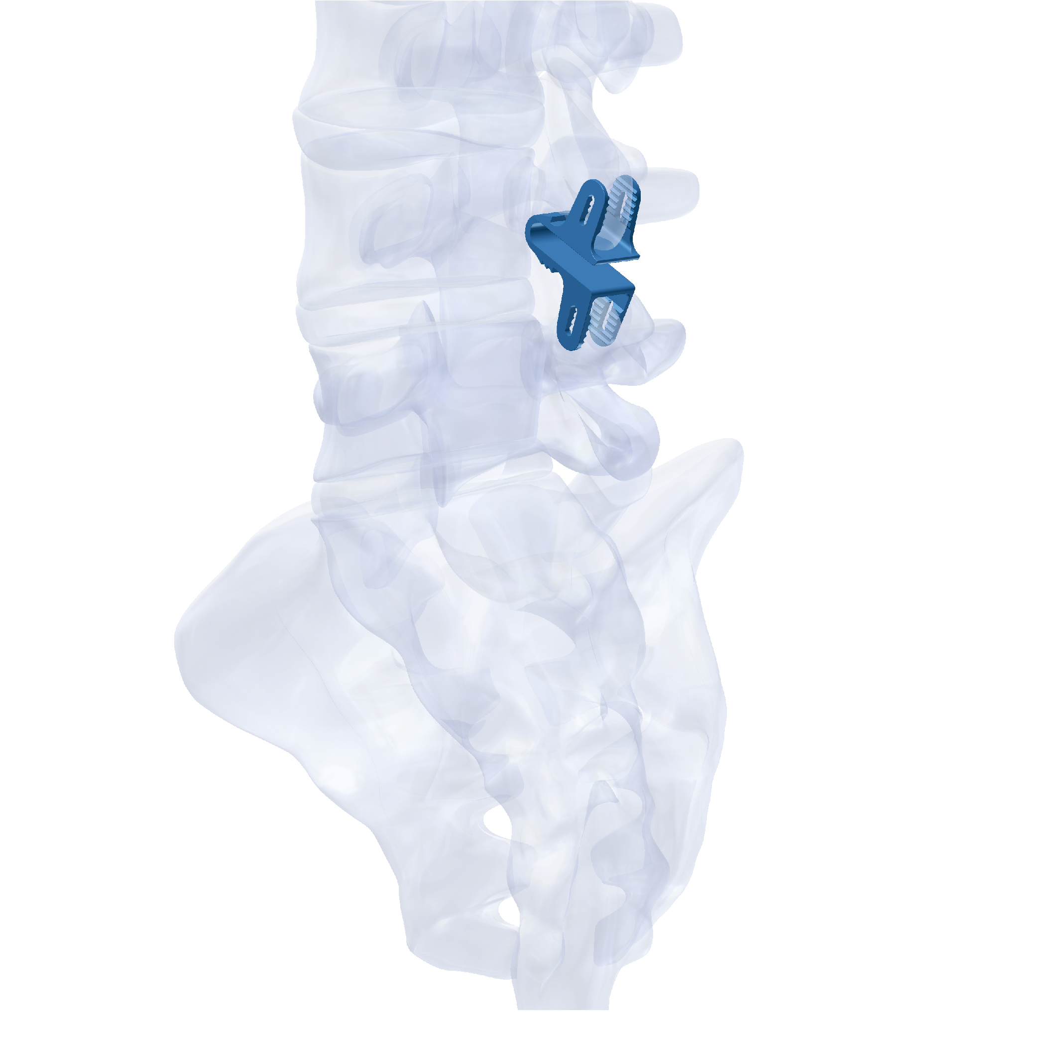 OCTANS Interspinous Device
