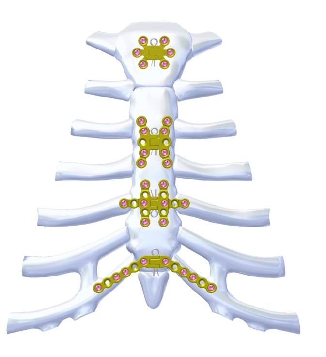 Severn Titanium Sternal Fixation System by Madison Ortho