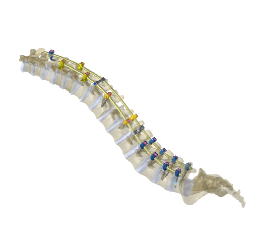 NEPTUNE 5.5 Deformity Spinal Hook Fixation System
