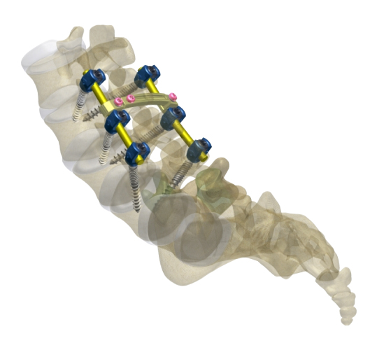 Neptune Thoracolumbar Posterior Spinal Fixation System by Madison Ortho