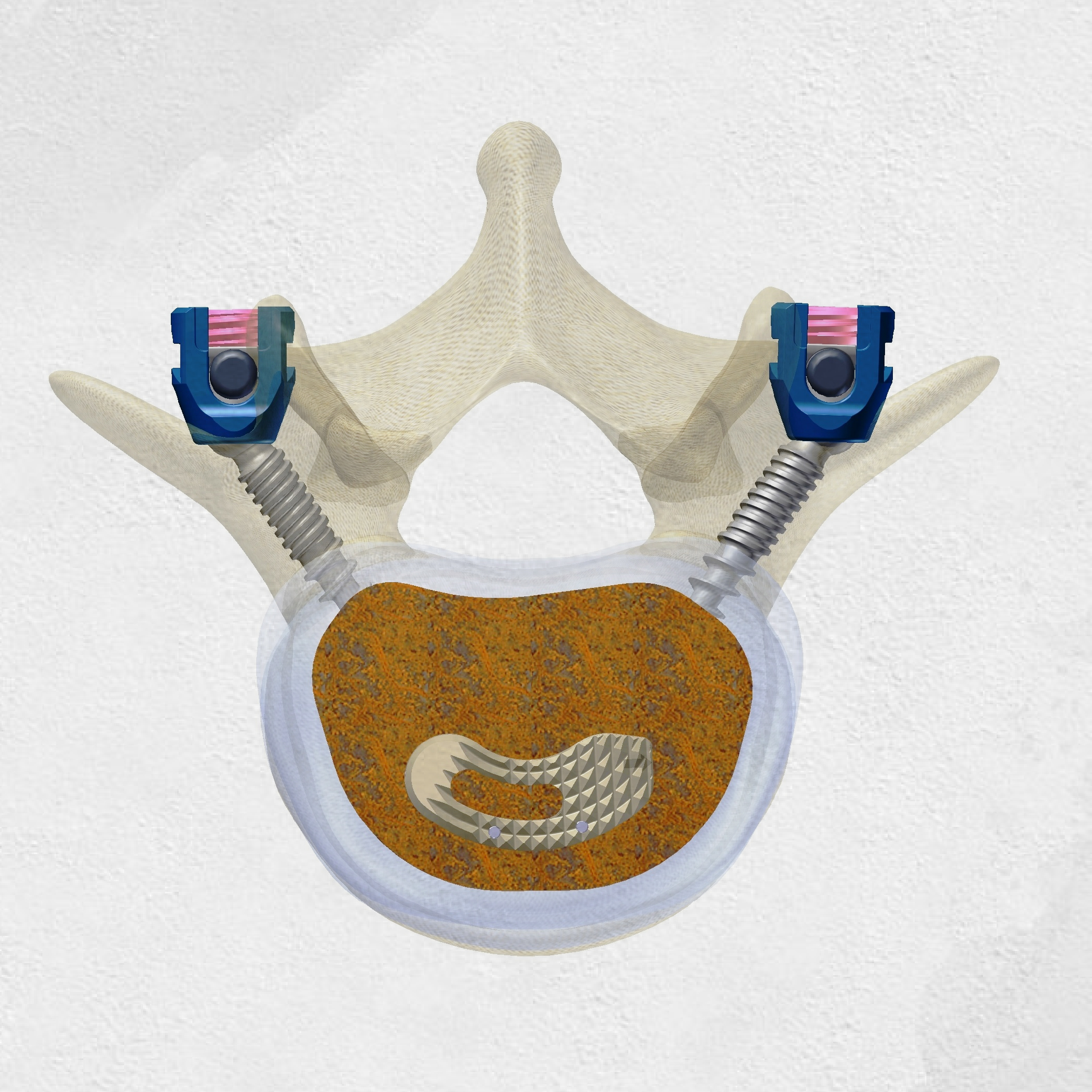 MERCURY PEEK TLIF Cage