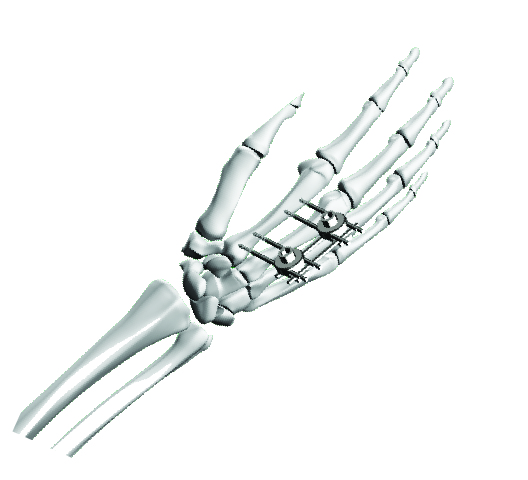 NIKES Modular External Fixator System for Femoral Trauma