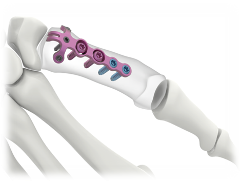 OVIEDO Rolando Hook Avulsion Fracture Plating System