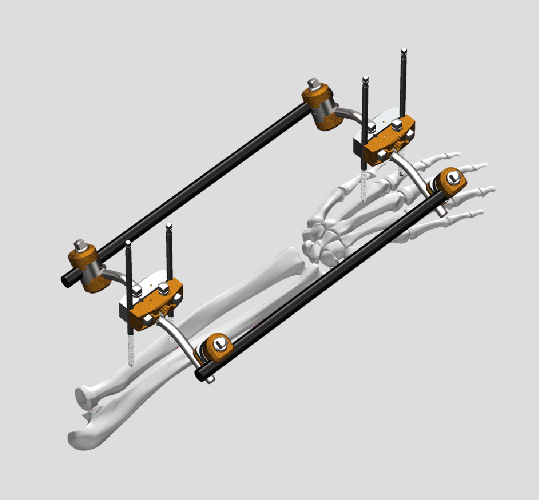 External Fixator Fixation Systems for complex fractures