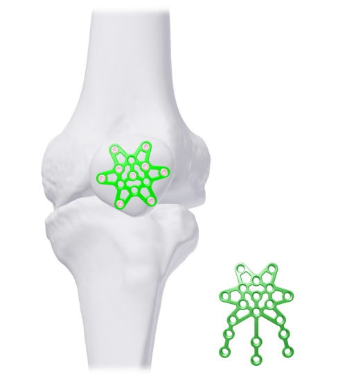 AMAZON Locking Anterior Patella Plates 2.7mm