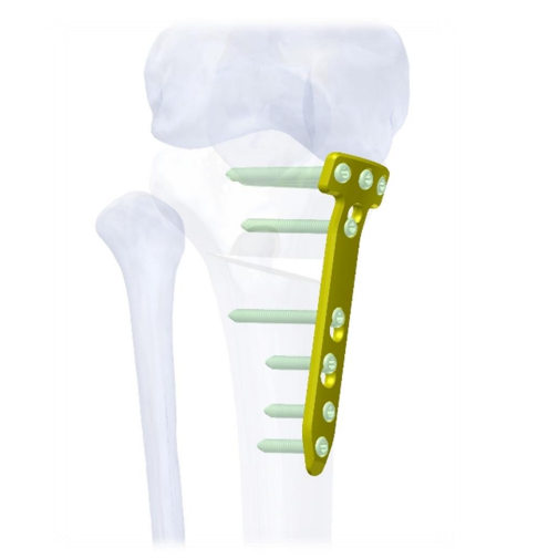 LENA LCP Peri-Knee Osteotomy System