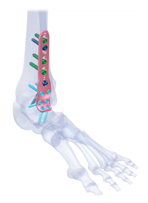 VOLGA VA-LCP Ankle Fusion Plating System
