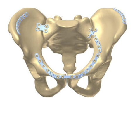 MANTARO Pelvic Plates System for acetabular fracture reconstruction