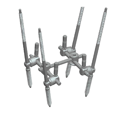 SATURN 3-D Spinal Posterior Fixation System