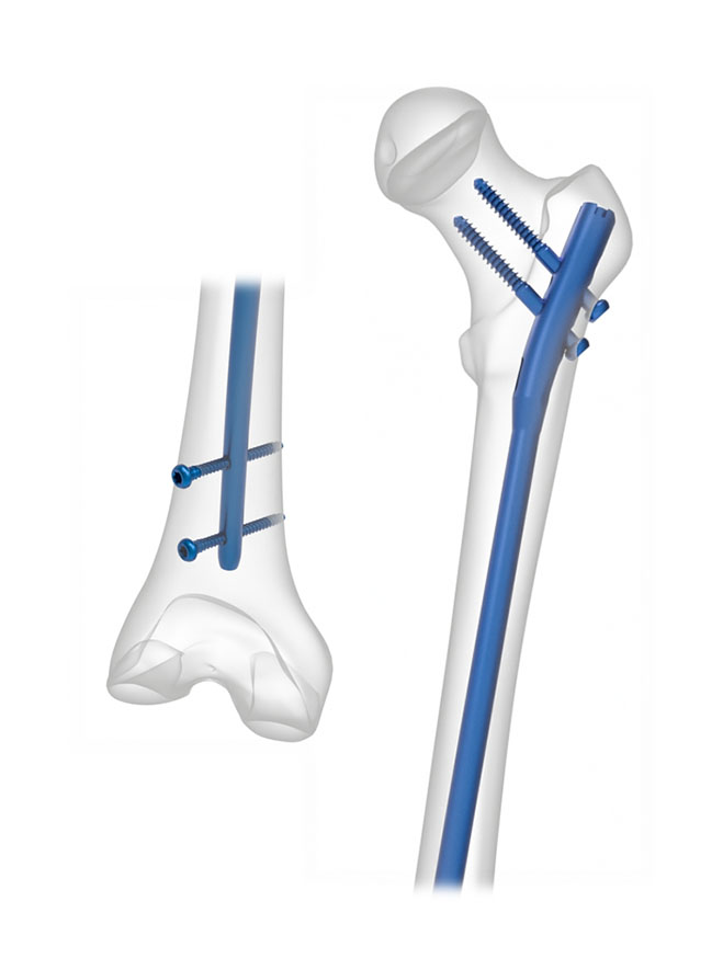 Meru Adolescent Lateral Entry Femoral Nailing System