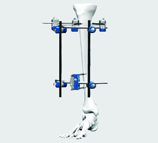 ARTEMIS Modular Lower Limb External Fixator