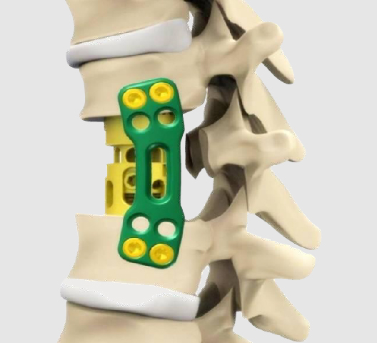 PRIMA TSLP Thoracolumbar Spine Locking Plates