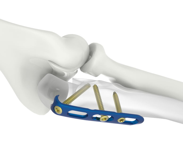 AMAZON LCP Hook Plate 3.5mm by Madison Ortho