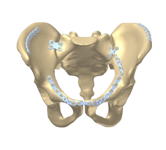 Hip Orthopedic Implants
