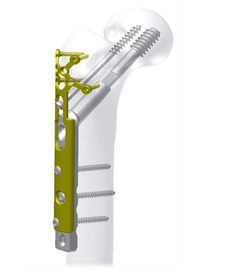 TIBER DHS-DCS Dynamic Hip and Condylar Screw System