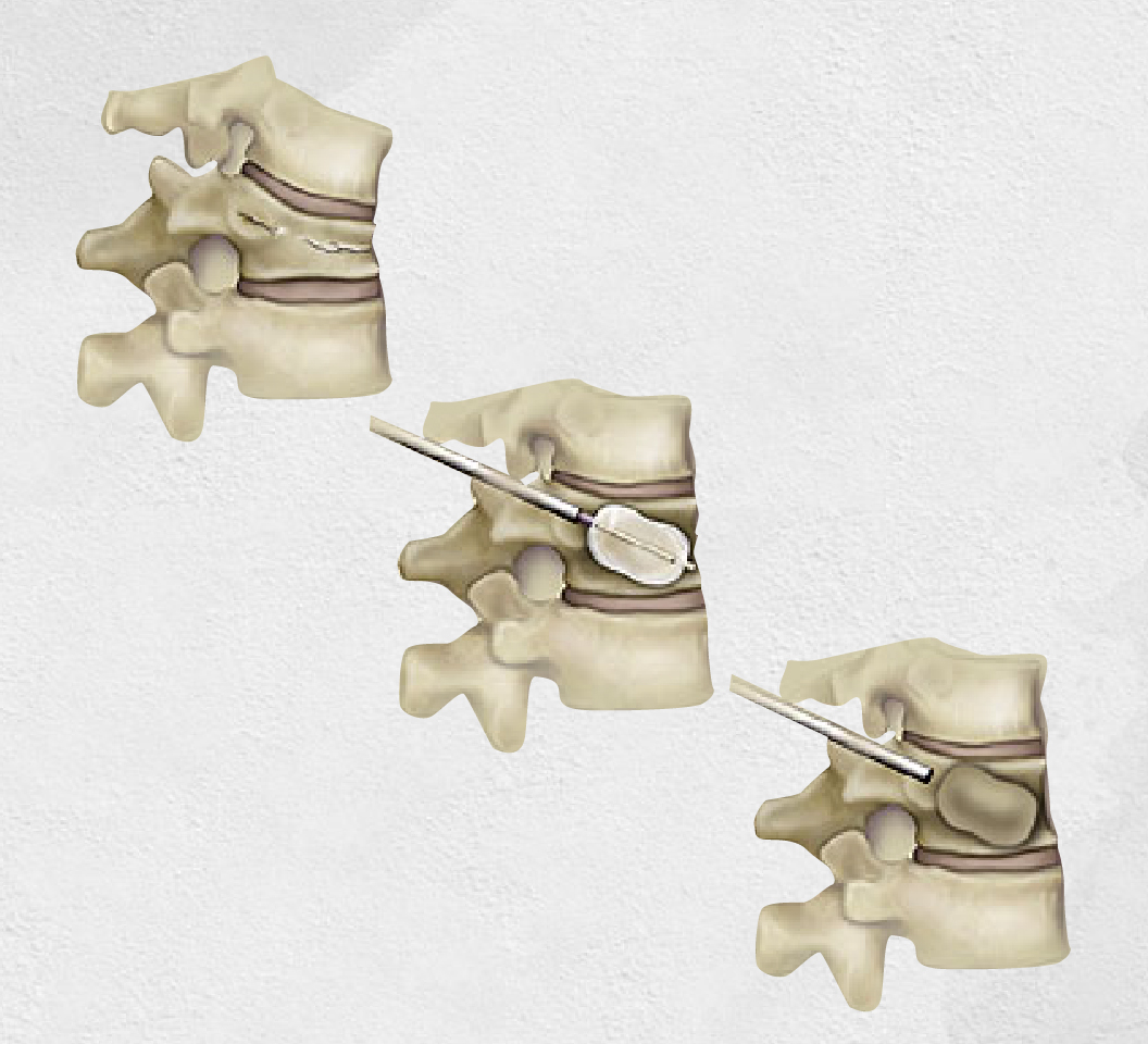 Kyphoplasty System for Vertebral Compression Fractures