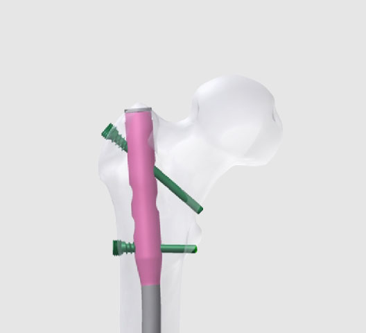 ALPS 3 in 1 Universal Nails