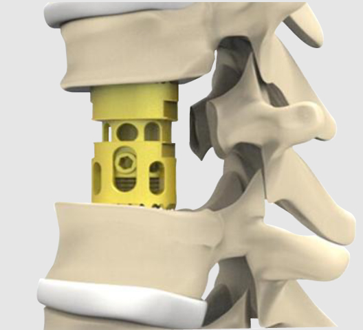 PRIMA VBR Vertebral Body Replacement Cages