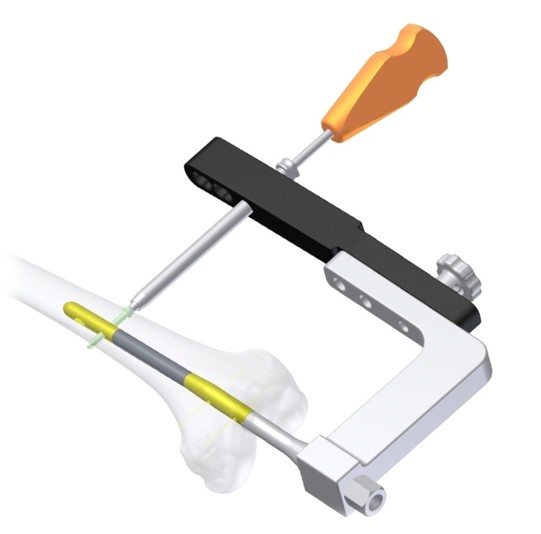Amatola Supracondylar and Retrograde Nailing System