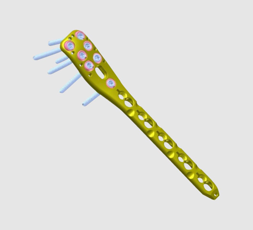 THAMES Variable Angle Elastic Locking Plates for Femur