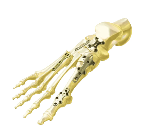 VOLGA Foot and Ankle LCP Plating System