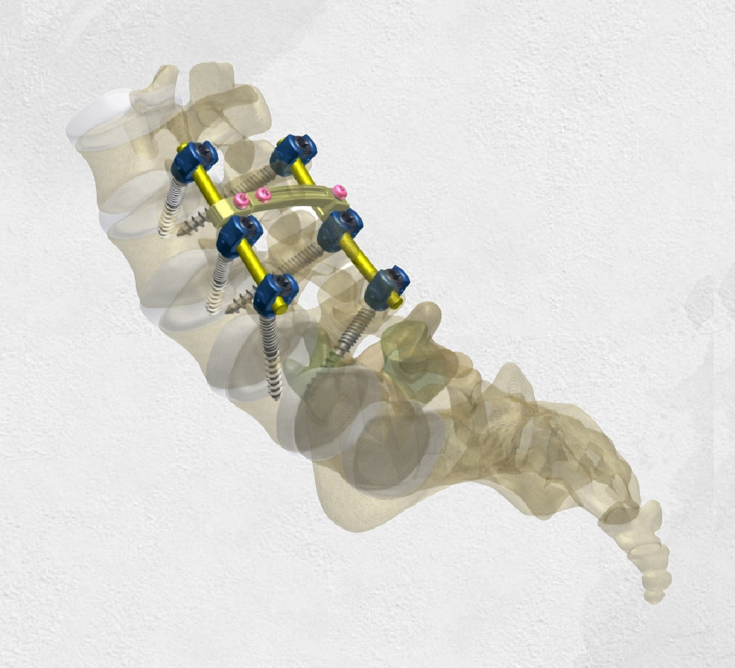 NEPTUNE 5.5 Degenerative Spinal Posterior Fixation System