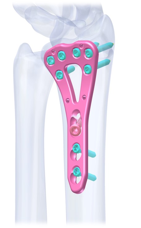 AMAZON VA-LCP Distal Radius Ulna Plates 2.4mm