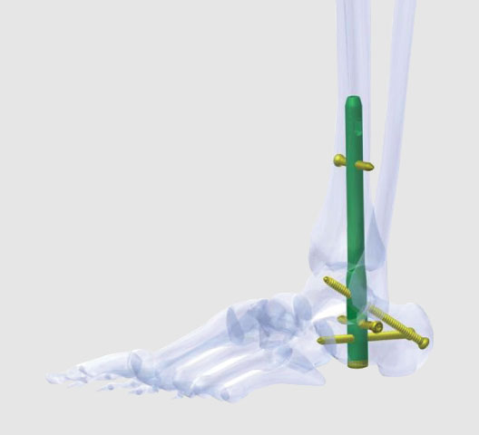 K-2 Ankle Arthrodesis Nails