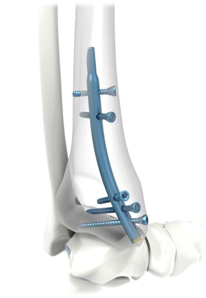 Lunana Retrograde Distal Tibia Nailing (DTN) System