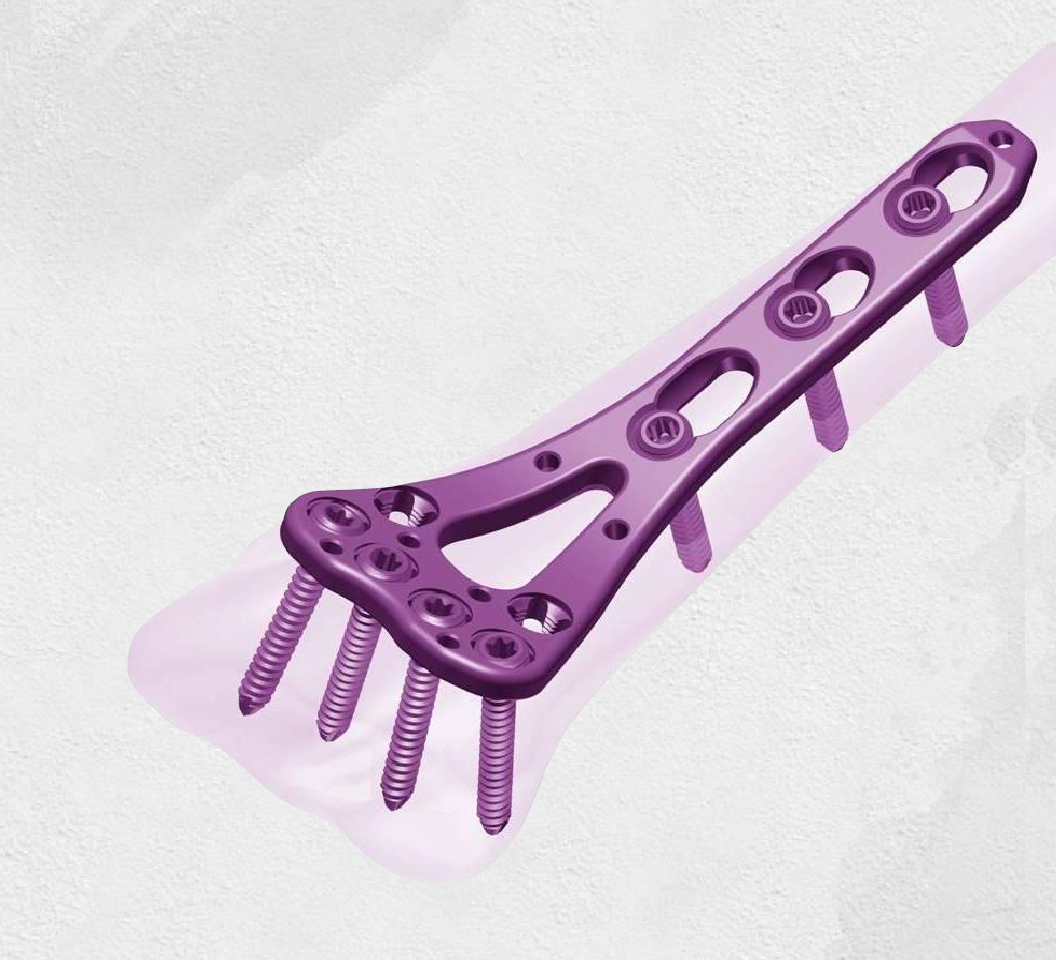 AMAZON LCP Plates - Femoral Locking Compression Plating System