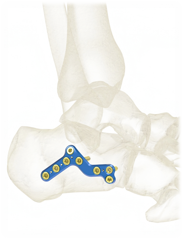 VOLGA Locking Calcaneal Plating System 3.5mm