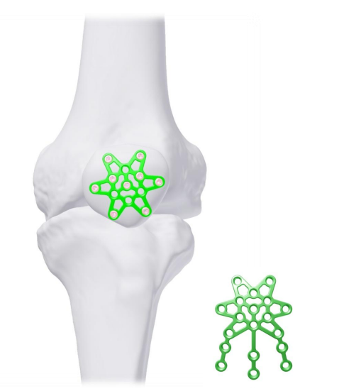 AMAZON Locking Anterior Patella and Distal Femoral Plates