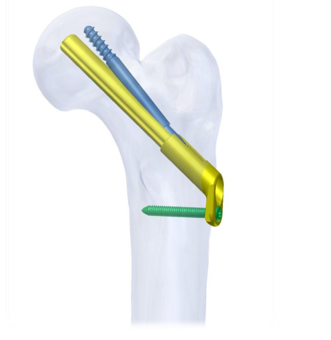 PARANA Femoral Neck System for Intracapsular Fractures