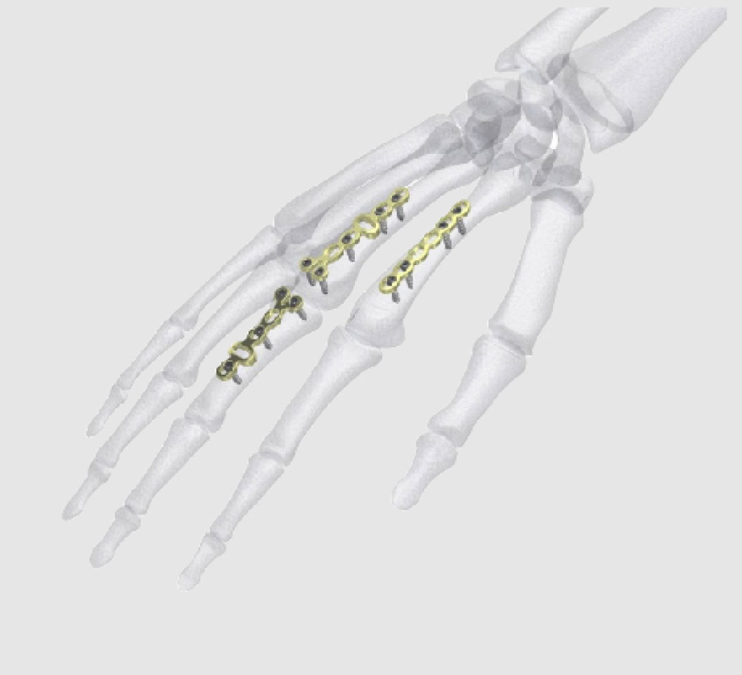 OVIEDO Hand LCP Plating System