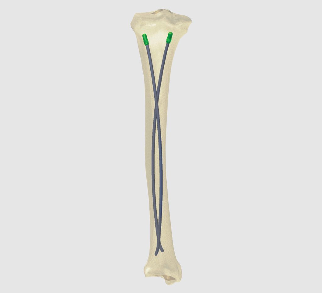 COLORADO Flexible Nails for Pediatric & Adult Femur Fractures