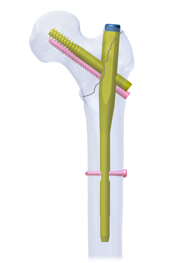 IGUACU Intertrochanteric Femur Nailing System