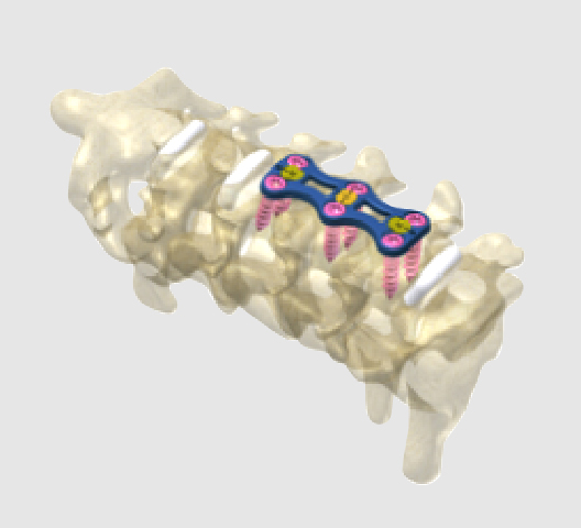 VENUS Anterior Cervical Plating System