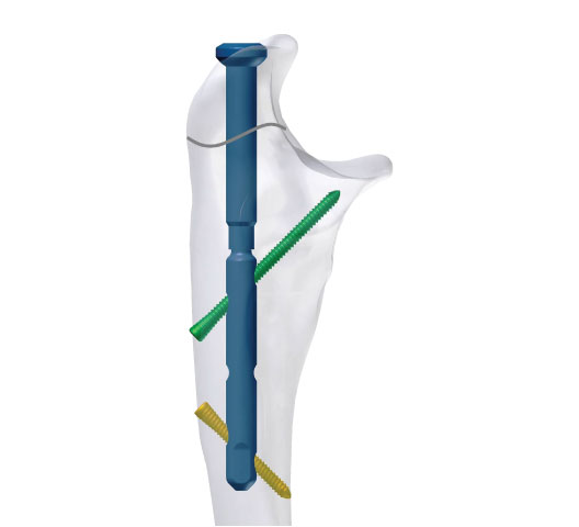 MCKINLEY Olecranon Osteotomy Nails