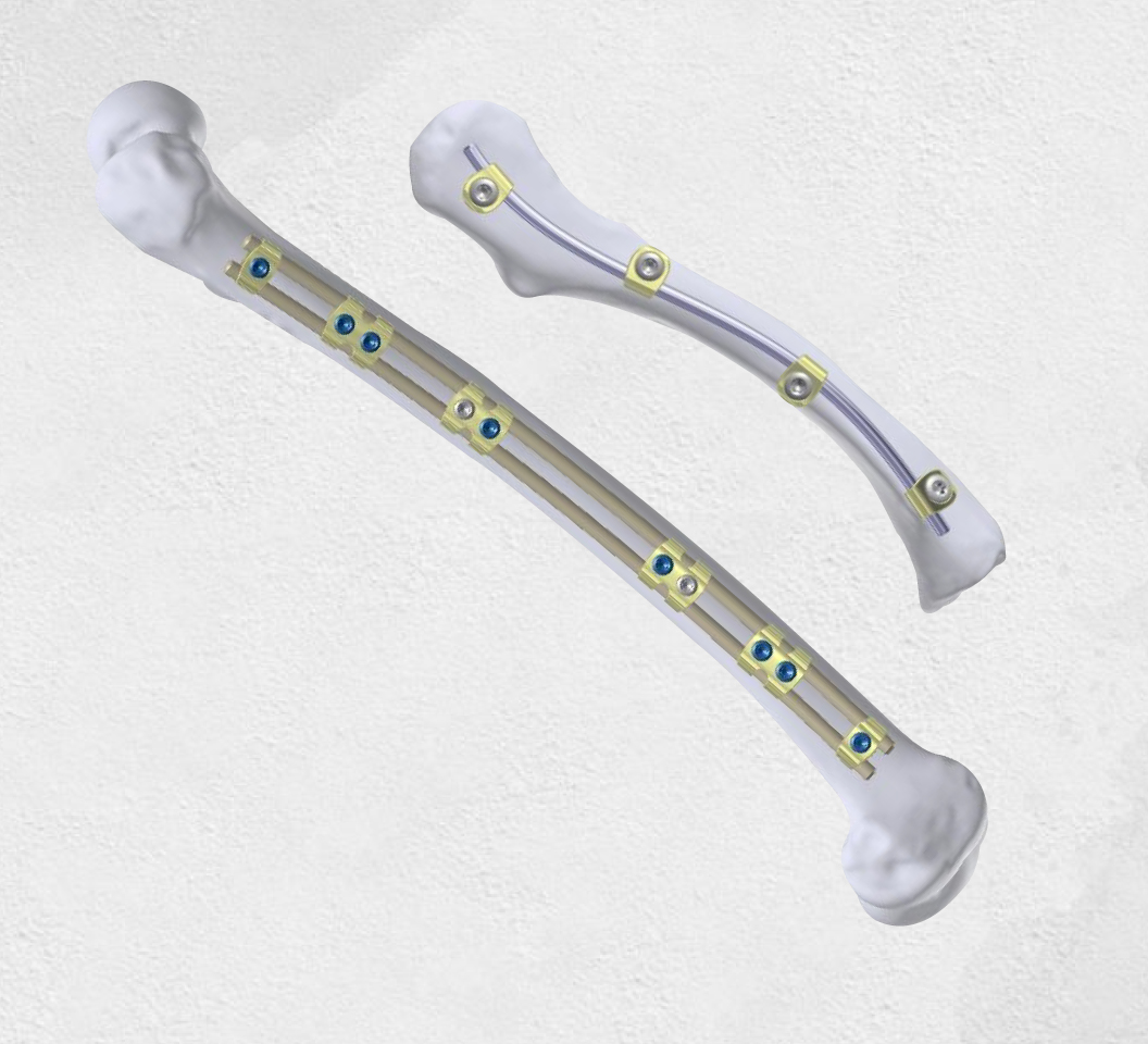 DONAV Locking Clamp Rod System for Femoral Stabilization