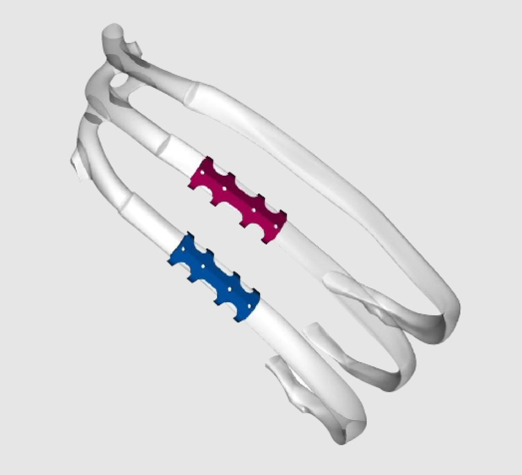 AUXO Rib Fixation Plating System