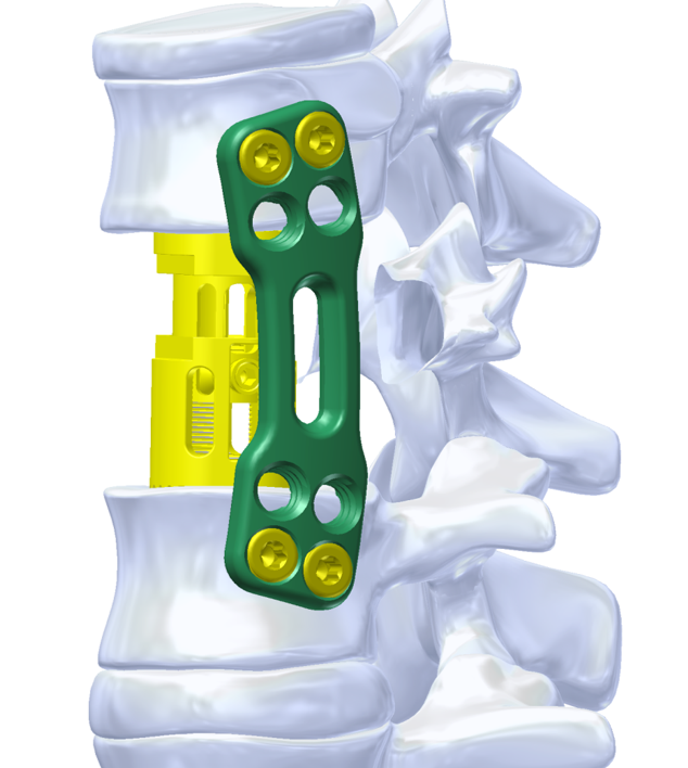 PRIMA VBR Vertebral Body Replacement and TSLP System