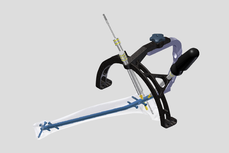 Intramedullary Nail Systems manufactured by Madison Ortho