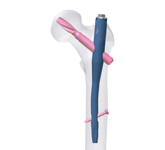 ATLAS PFNA Femur Nails