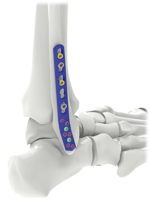 AMAZON LCP Posterolateral Distal Fibula Plate 2.7/3.5mm
